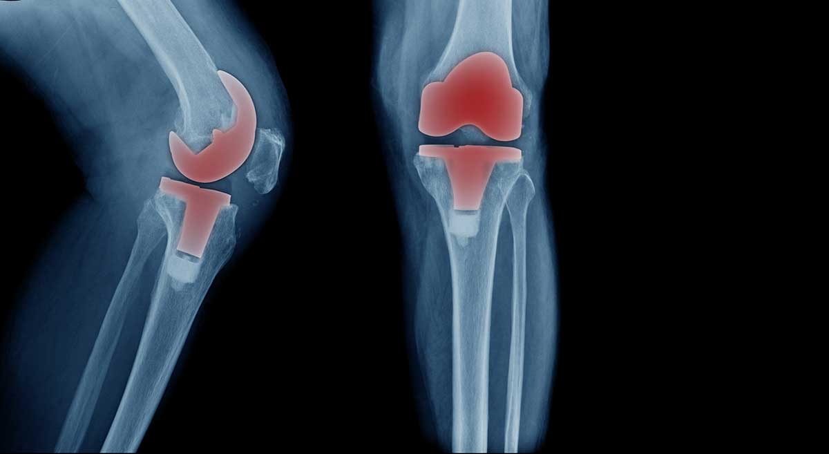 is-knee-replacement-worth-it-magnolia-regional-health-center