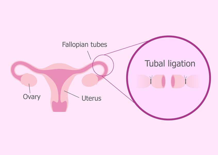 Tubal Ligation Procedures Magnolia Regional Health Center