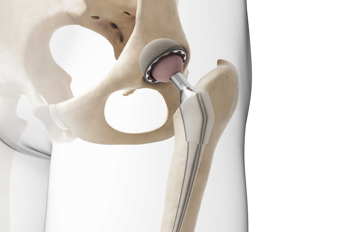 What Happens During Total Hip Replacement? Magnolia Regional Health