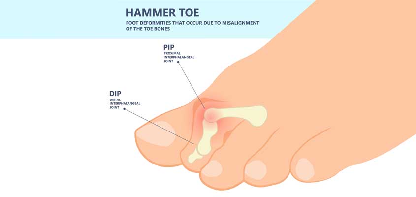 Making Sense of Your Changing Digits—What Is a Hammer Toe? - Magnolia  Regional Health Center